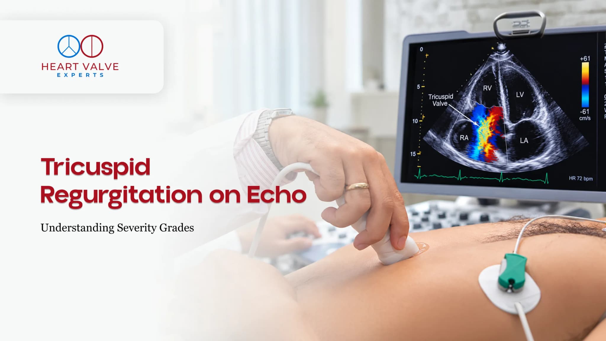 What Is Tricuspid Regurgitation and What Does It Mean for Your Heart?