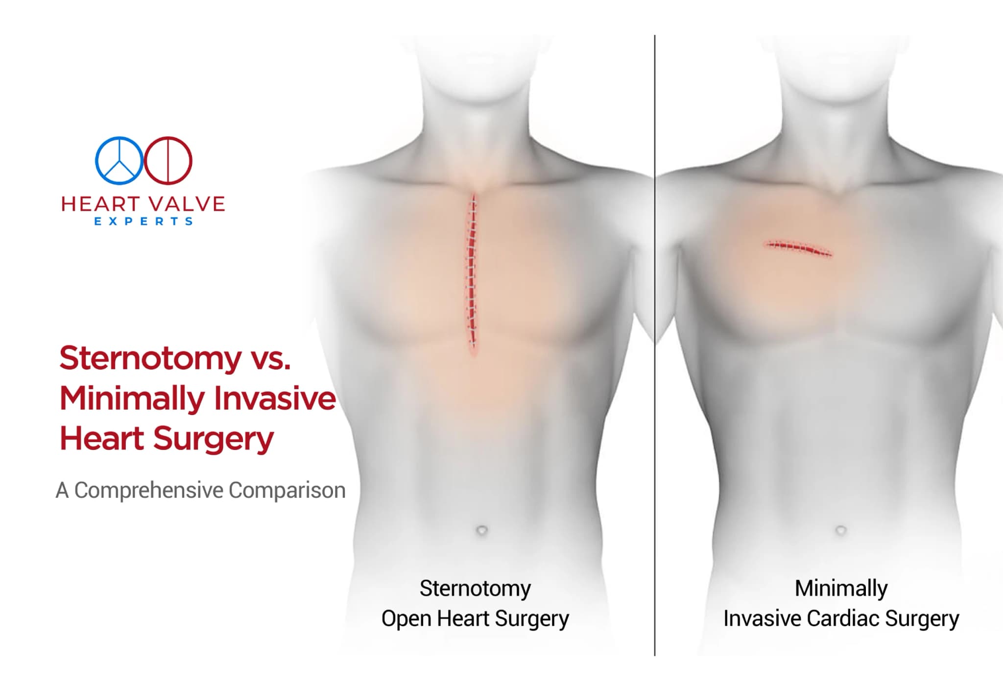 Strnotomy Sternotomy vs Minimally Invasive Heart Surgery: Key Differences