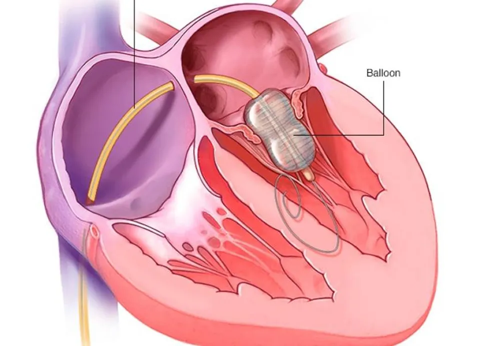 Balloon Valvuloplasty