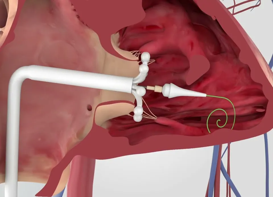 Tricuspid Valve Intervention