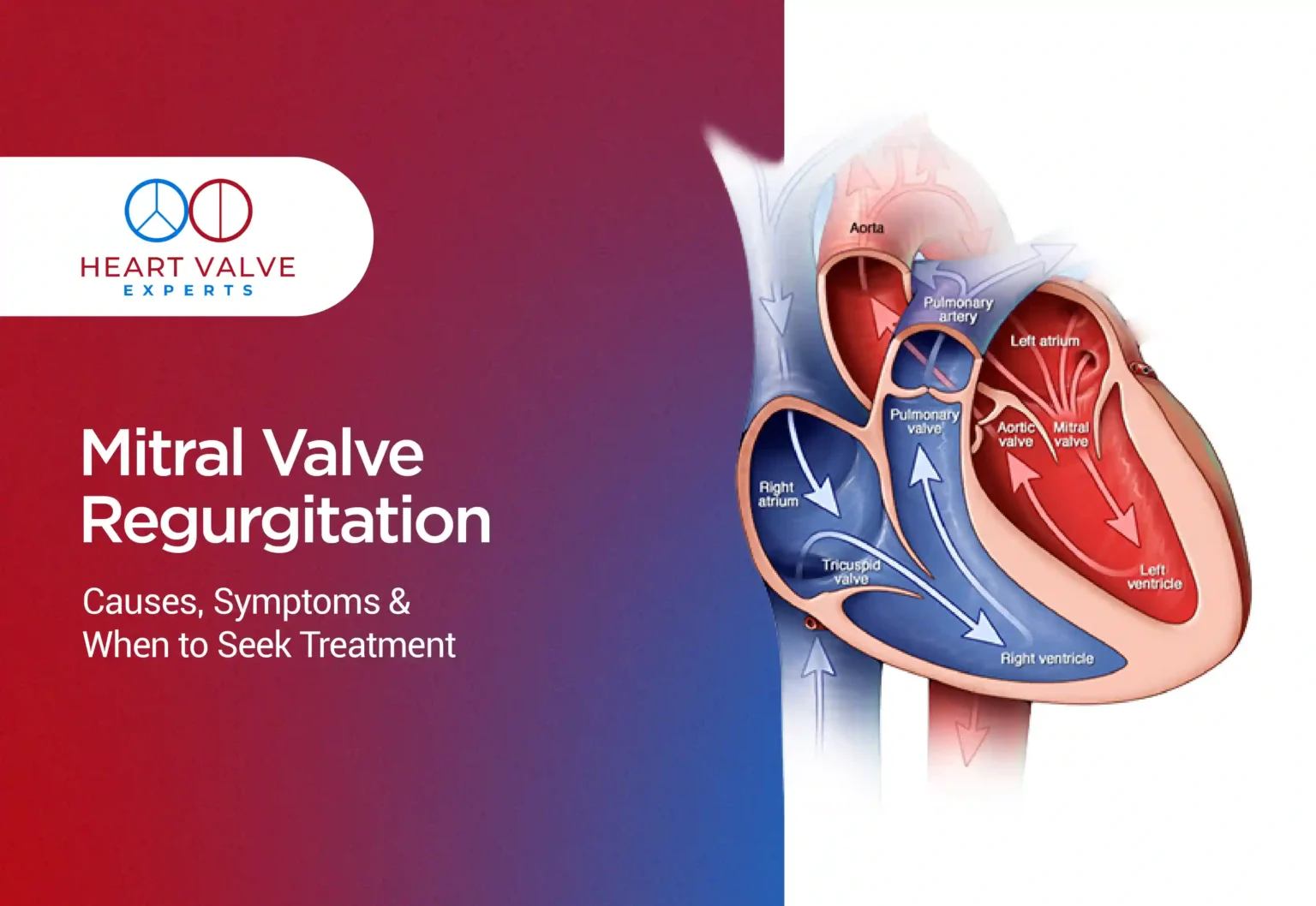 mitral valve regurgitation